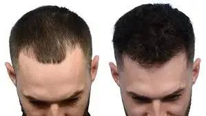 Hair Transplant No Finasteride: What You Need to Know